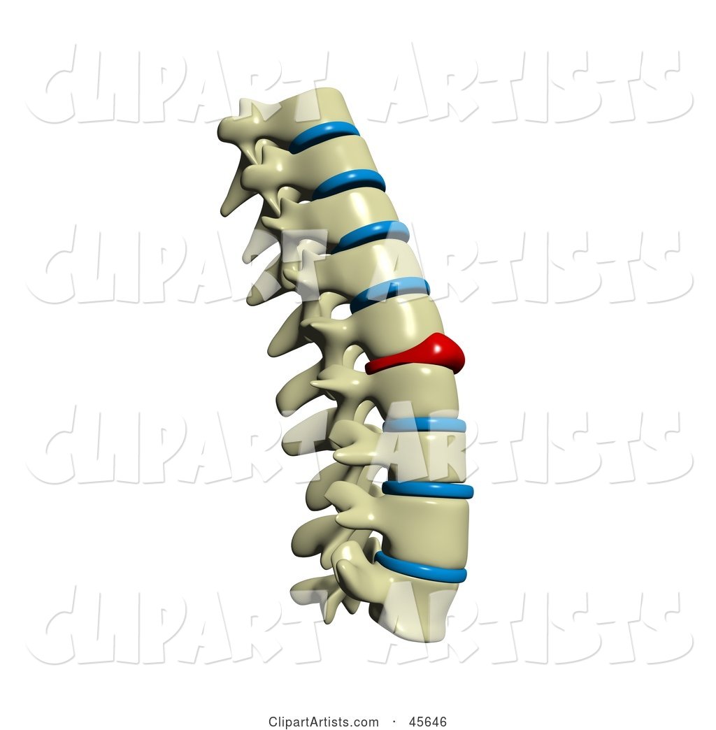 Human Spine with a Red Injured Spinal Disc