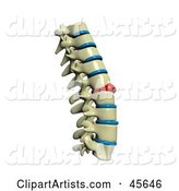 Human Spine with a Red Injured Spinal Disc